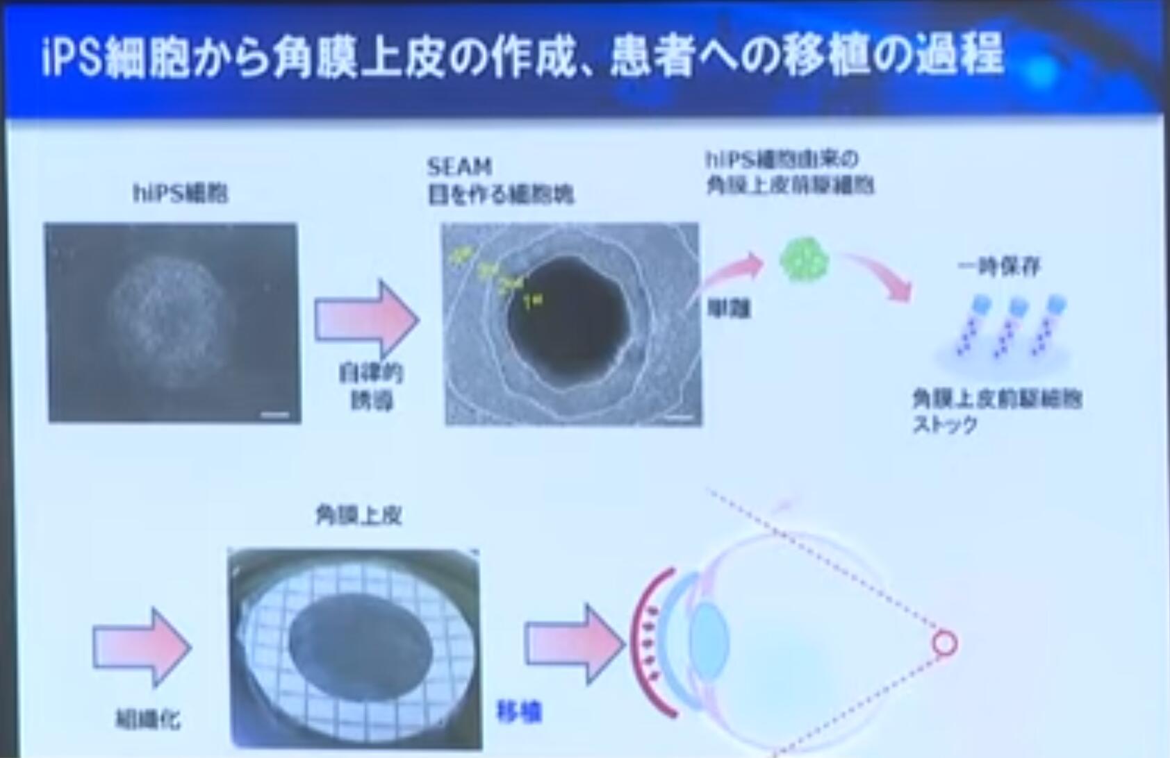 日本大阪大学公布世界首例ips细胞来源的角膜移植结果 恢复视力 干细胞信息平台