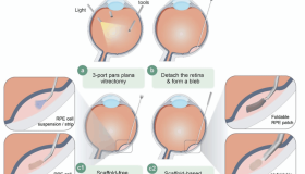 比较人iPSC 与 ESC 的临床应用现状与进展 比较人iPSC 与 ESC 的临床应用现状与进展