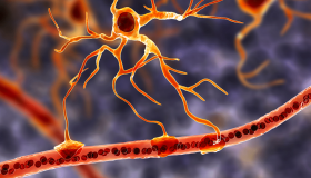 利用干细胞治疗渐冻症的思路分析 利用干细胞治疗渐冻症的思路分析