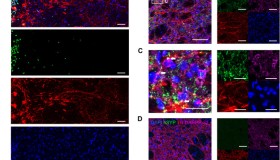 帕金森:人胚干细胞衍生多巴胺前体细胞移植临床试验初显疗效 帕金森:人胚干细胞衍生多巴胺前体细胞移植临床试验初显疗效