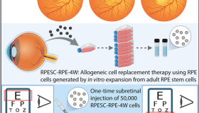 Cell Stem Cell: 干细胞移植治疗老年性黄斑变性展现早期安全性与视力改善 Cell Stem Cell: 干细胞移植治疗老年性黄斑变性展现早期安全性与视力改善