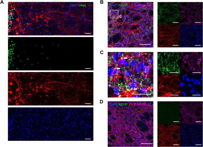 帕金森:人胚干细胞衍生多巴胺前体细胞移植临床试验初显疗效 帕金森:人胚干细胞衍生多巴胺前体细胞移植临床试验初显疗效